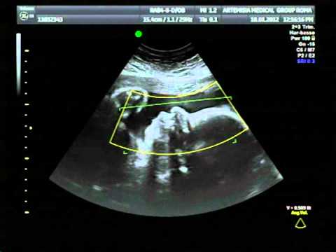 Dolore al collo con osteocondrosi che curare 20 ÑƒÐ¿Ñ € Ð ° Ñ Ð¶Ð½Ðμний, Ñ Ñ, ÐμÐ¾Ñ Ð¾Ð½ÐÑ ... € оР· Ð ° виÐÐμо