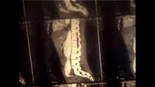 Surgical Radiology - CT abdomen 3 kidney