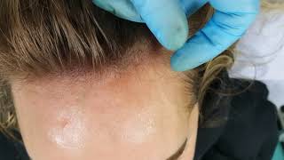 Female Hairline Scalp Micropigmentation Density by El Truchan @ Perfect Definition
