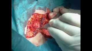 hidradenitis-surgery