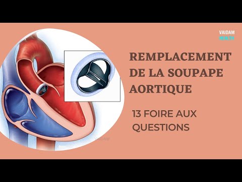 REMPLACEMENT DE LA SOUPAPE AORTIQUE