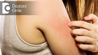 5 Top Causes of Itchy skin? - Dr. Urmila Nischal