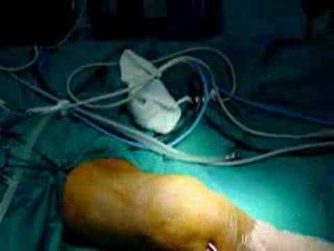 Arthroscopy In Septic Inflammation Of Knee Joint