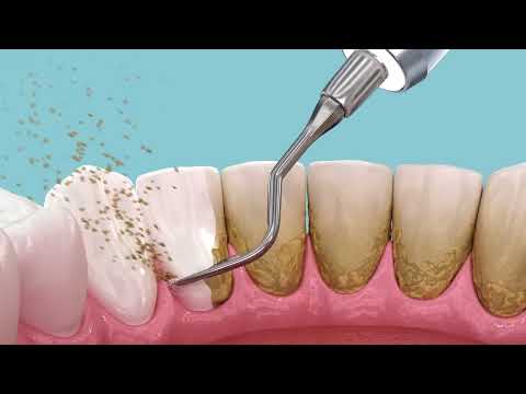 Dental Hygiene — video thumbnail