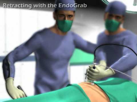 EndoGrab from Virtual Ports -  Less Invasive Surgery