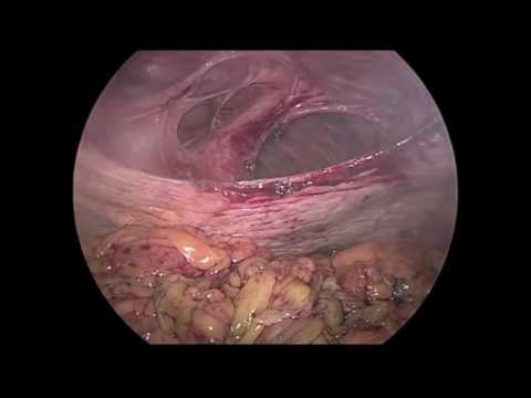 Laparoscopic Diaphragmatic Hernia Repair in the Setting of Acute Small Bowel Obstruction