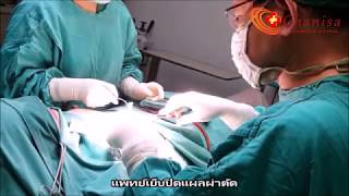 ลดขนาดหัวนม
