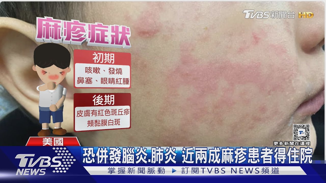 疫苗接種率下滑3%!美國爆麻疹疫情 10年首見死亡病例