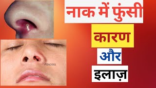 Epi 1 | Boils in Nose/ नाक में फुंसी /कारण और इलाज़। Painful sores in nose/Pimple on side of nose/
