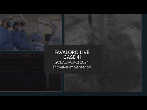 Favaloro Live Case N° 41 - SOLACI-CACI 2024 - TricValve Implantarion