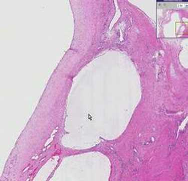 ganglion toxoplazmózis