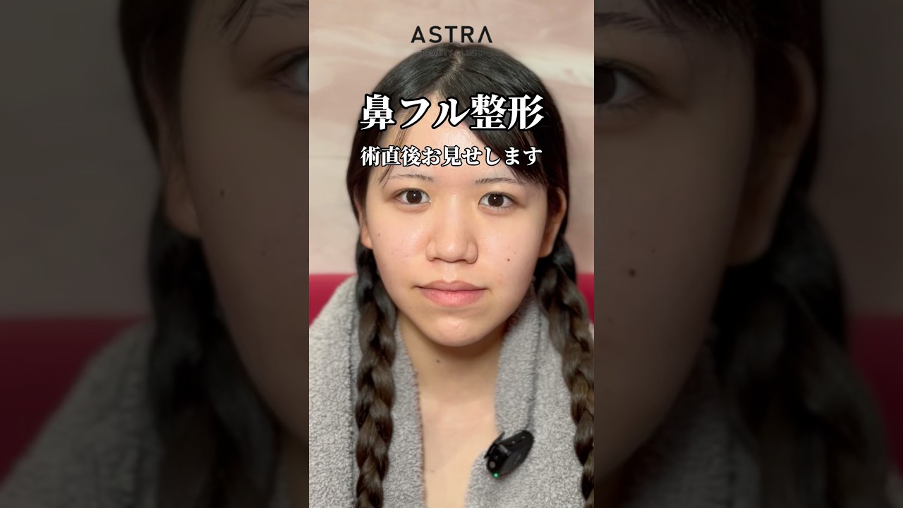 術直後お見せします💖#astrabeautyclinic  #アストラビューティークリニック #塩満恵子 #鼻整形 #美容整形 #忘れ鼻