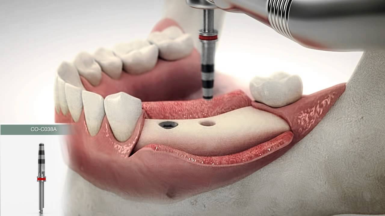 Cortex Implantation Procedure