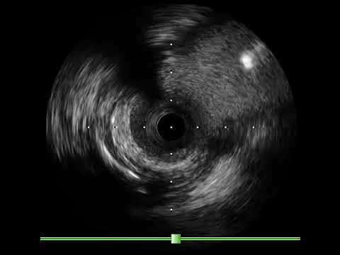 Provisional LM  LAD stenting TAP technique
