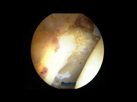 Disabilità osteocondrosi della colonna cervicale Cronico mal di schiena che lo fanno