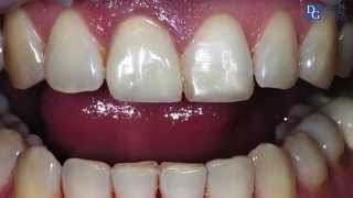 We're happy to present you our temporary solution for implants