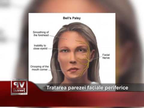 Tratarea parezei faciale periferice