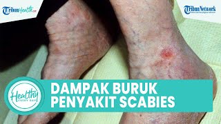 Dampak Buruk Scabies pada Penderita Diabetes dan HIV, Simak Ulasan dr Az Zuhruf
