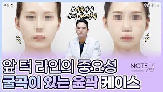 [유.케.리] CT로 보는 케이스 리뷰 l 광대축소 +핀리스 브이라인 l 갸름한 앞 턱 l 굴곡진 광대 l