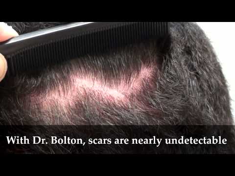 Jay's Undetectable Scar: 4mo