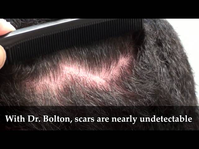 Jay's Undetectable Scar: 4mo