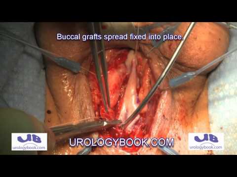 One-Sided Dorsal Onlay Urethroplasty For Urethral Stricture Disease