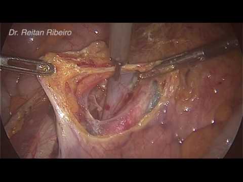 Laparoscopic staging for endometrial carcinoma - Part 2 of 2