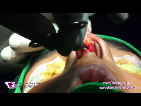 Rhinoplasty Surgery During Workshop