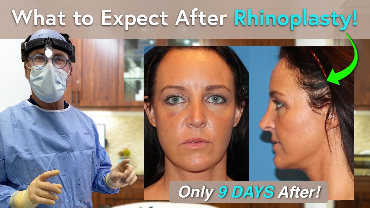 What Can I Expect During Rhinoplasty Recovery