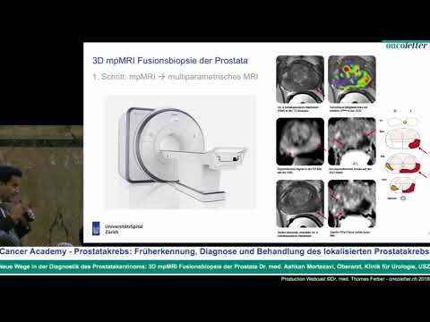 Wie ein Mann durch die Prostata gefallen Prostata TRUS Abakan