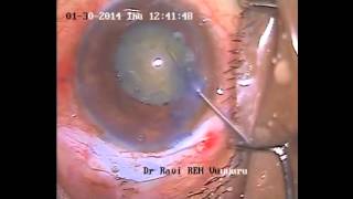 preview picture of video 'complicated cataract management using kuglens hooks'