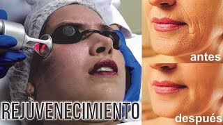 REJUVENECIMIENTO * ROSTRO MÁS JOVEN CON LÁSER CO2  - ETERNA JUVENTUD