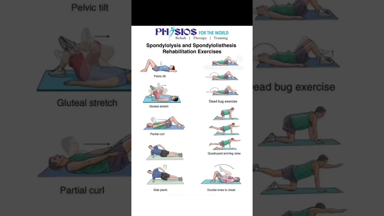 Spondylitis And Spondylolisthesis Rehabilitation Exercises