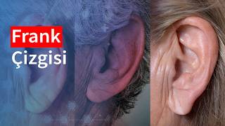 Frank Çizgisi Nedir? Kalp Hastalığı Belirtisi mi? | Medical Park