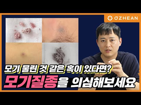 여성, 아이 얼굴에 잘 생기는 딱딱한 혹 모기질종!