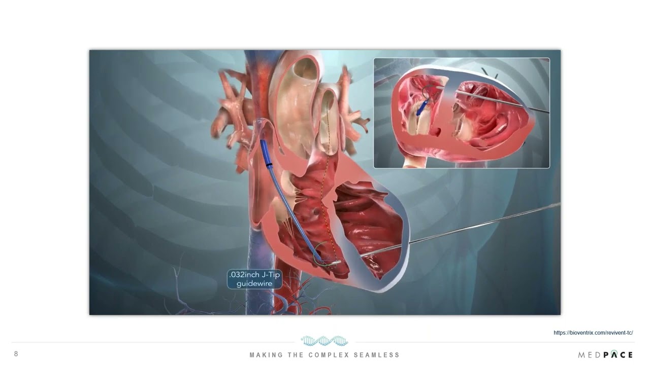 The MedTech Horizon: Exploring the Frontier of Cardiovascular Device Development in Heart Failure