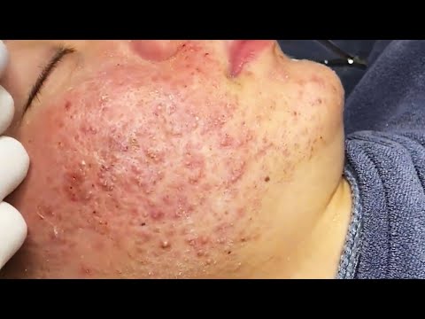 Blackhead removal Video #64 #Blackheads #blackheadsremoval #sebum