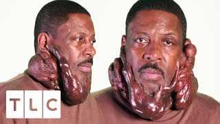 Chronic Keloids Are Seriously Impacting This Man&#39;s Life | Body Bizarre