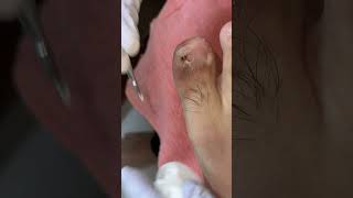 Ep_8291 Big ingrown toenail removal 👣 โหพี่..รู้แล้วครับทำไมเจ็บ 😄 (clip from Thailand)