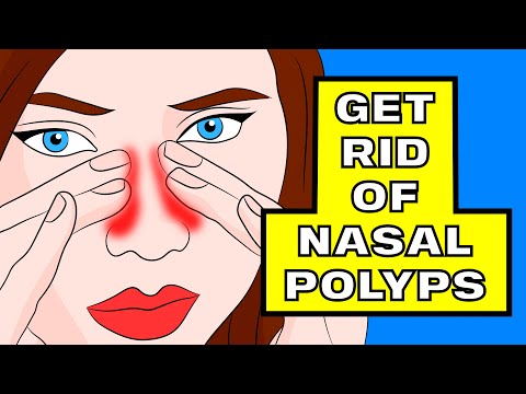 How to Shrink your Nasal Polyps in under 3 minutes WITHOUT surgery