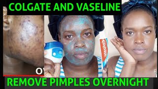 How to remove pimples and blackheads overnight | Colgate and Vaseline facemask