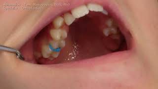 CÁCH ĐẶT THUN TÁCH KẺ