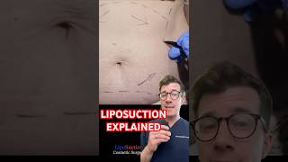 Doctor explains LIPOSUCTION for weight loss #shorts