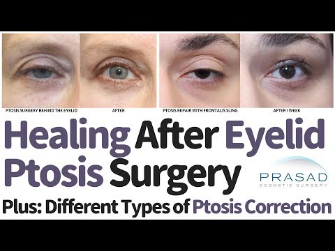 Different Types of Eyelid Ptosis, Surgical Correction Techniques, and Expected Healing Time