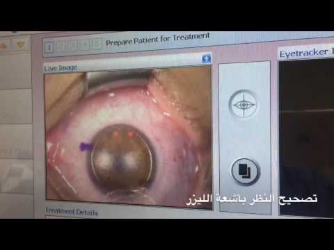 عملية الفيمتوليزك لايف - عيادات د أحمد شلش لطب و جراحات العيون