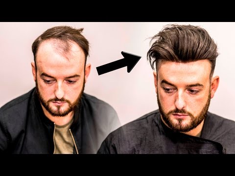 Mens Hair Loss Treatment | Hairstyle Transformation - Does it Work?