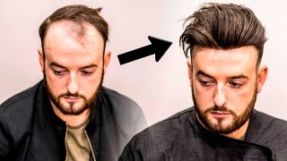 Mens Hair Loss Treatment | Hairstyle Transformation - Does it Work?
