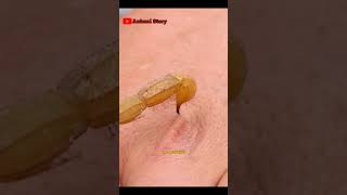 Download lagu Beginilah Reaksi jika Terkena Racun Kalajengking mp3 Download lagu Beginilah Reaksi jika Terkena Racun Kalajengking mp3