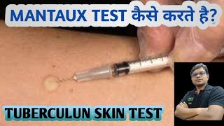 Mantoux test | TST | PPD | Tuberculin skin test | Diagnosis of TB.