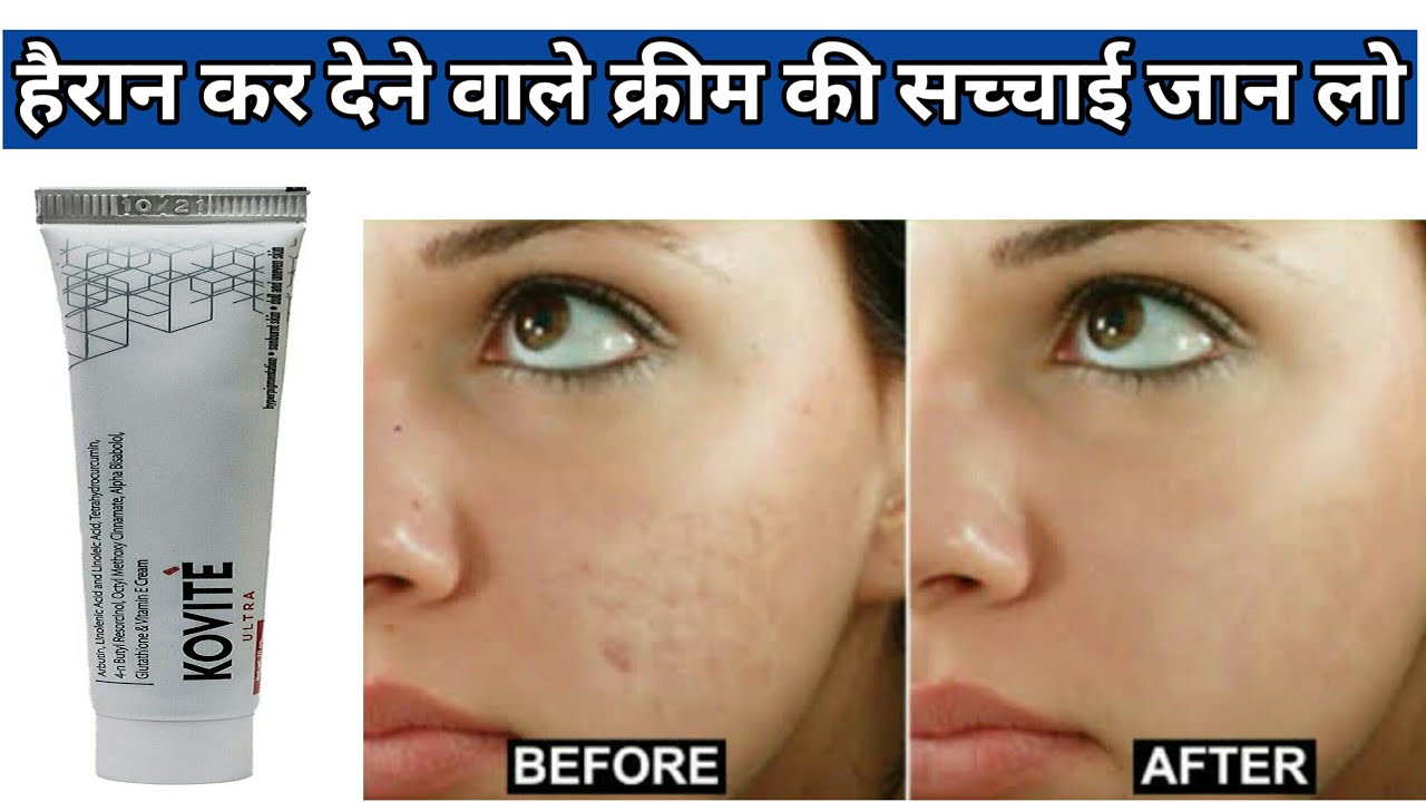 Kovite Active Cream | Kojivit Ultra cream uses | How to use kovite Ultra | Kovite ultra cream review